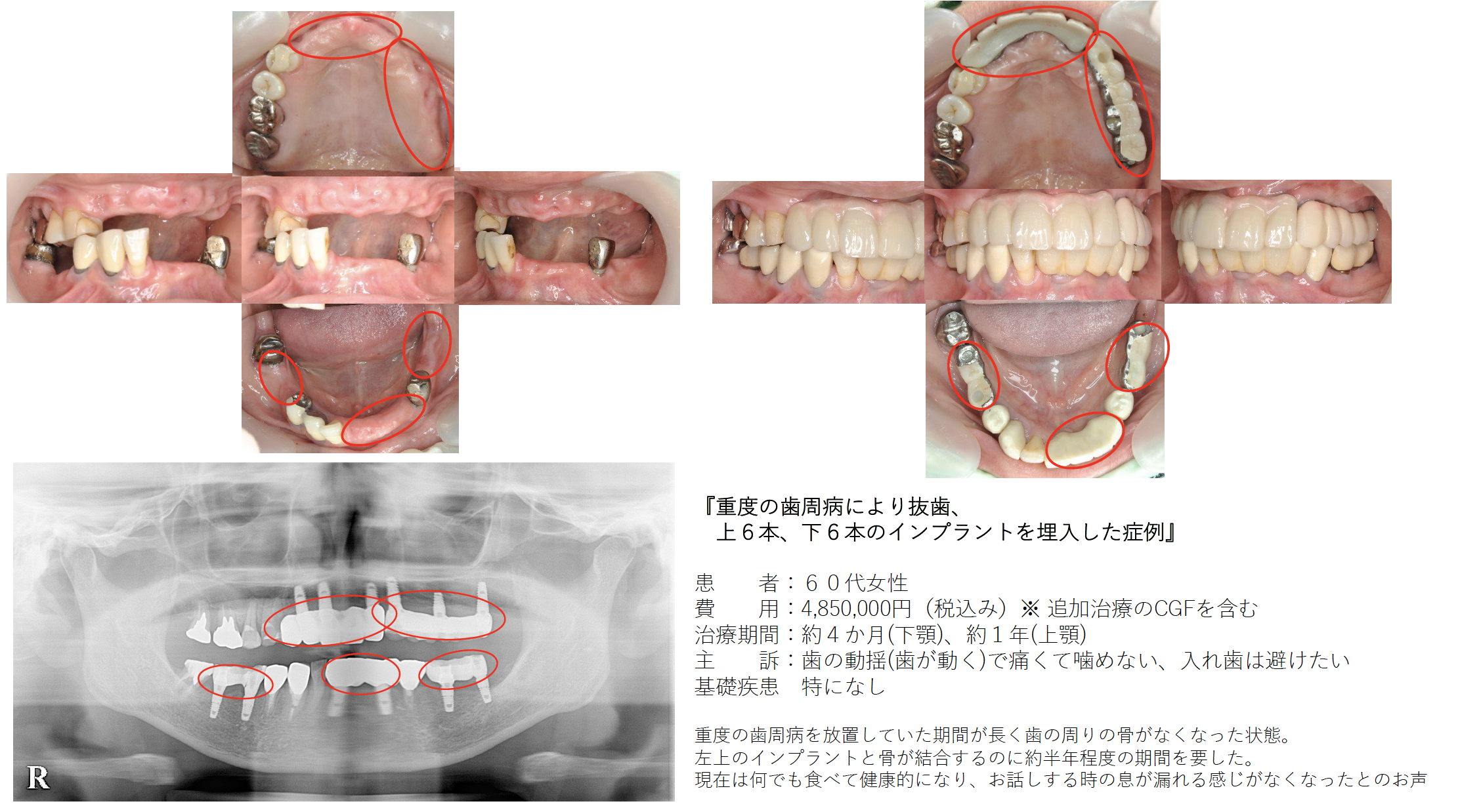 重度の⻭周病により抜⻭、 上6本、下6本のインプラントを埋⼊した