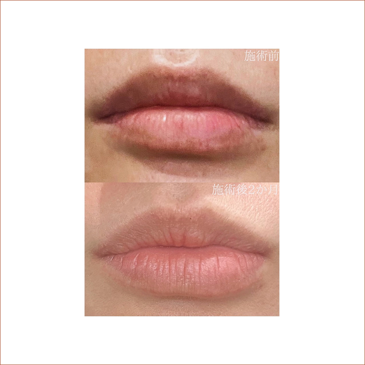 ローマピンク（リップ）ビフォーアフター - OBSエステ宮崎