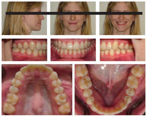 When the Class III Patient Says No | Orthodontic Products