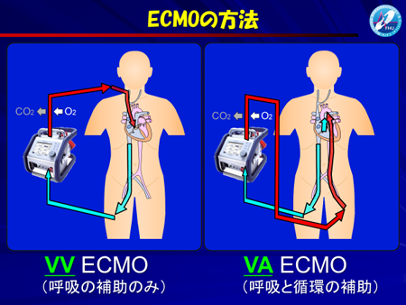 ECMO – 藤田医科大学医学部 麻酔・集中治療医学講座（旧 麻酔・侵襲