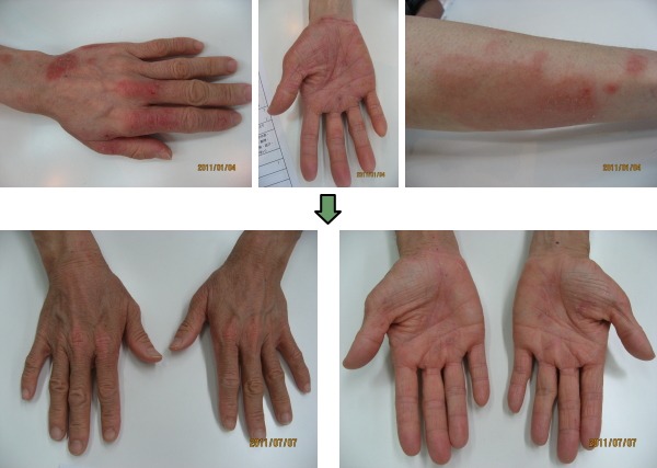 掌蹠膿疱症(しょうせきのうほうしょう）④ - こだいら漢方堂