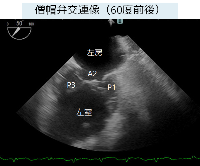 経食道心エコー検査 TEE: transesophageal echo│医學事始 いがくこと