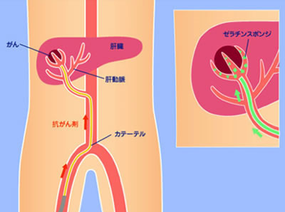 経皮的ラジオ波焼灼術：RFA ／ 肝動脈化学塞栓術：TACE | 治療・手術