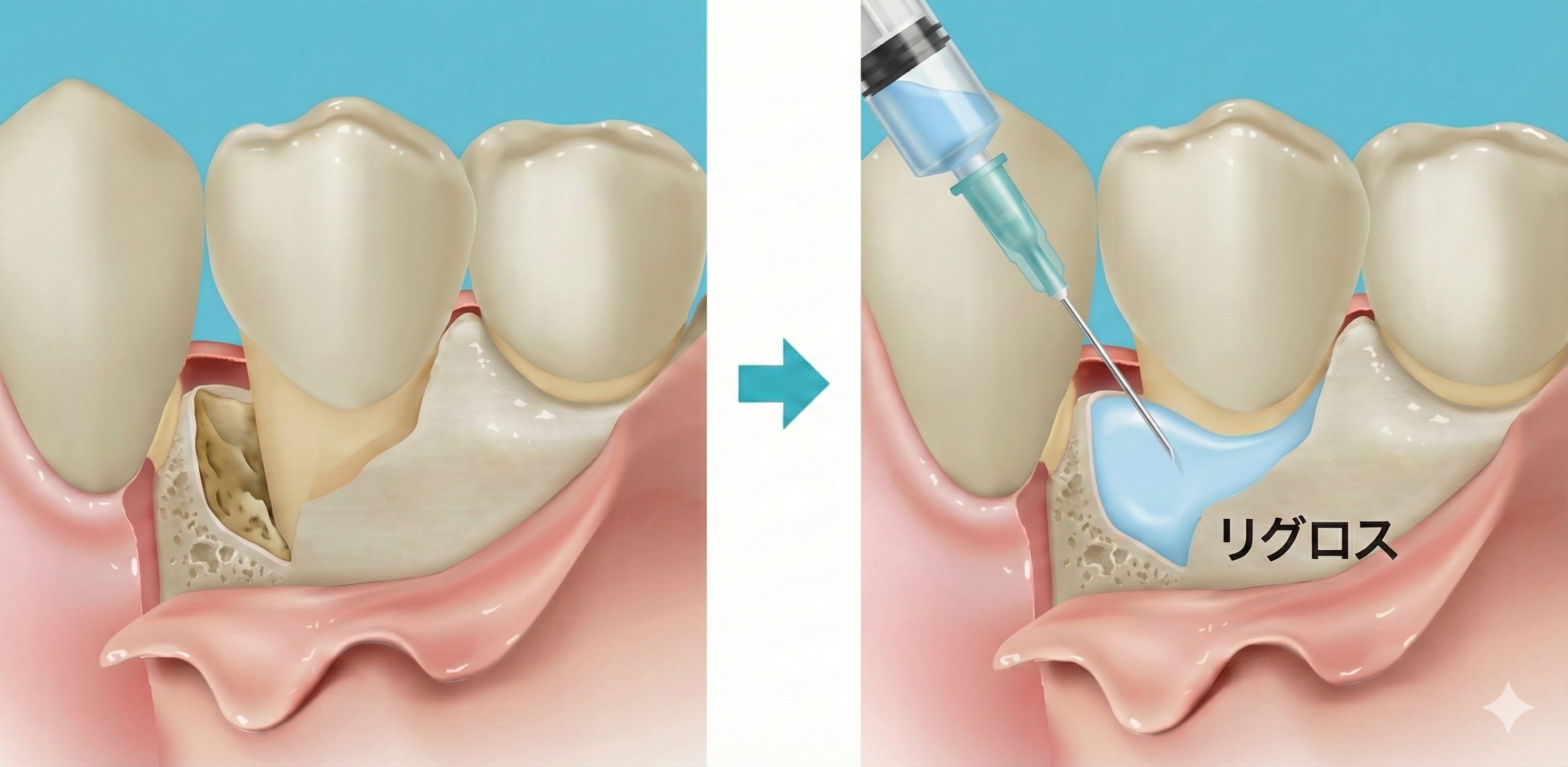 リグロスによる歯周組織再生治療（保険診療） – さいとう歯科クリニック