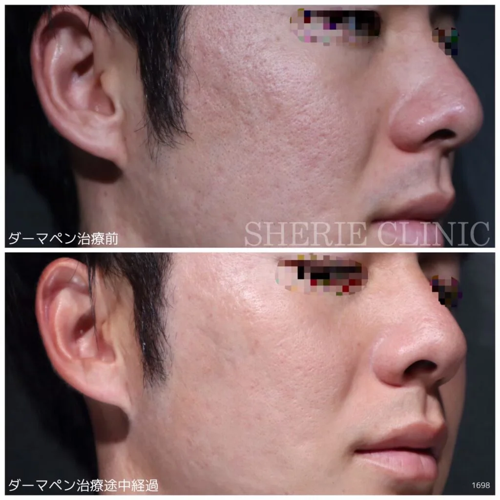 セルフダーマペンってどうなの？ │ シェリークリニック｜ニキビ治療