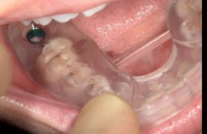 インプラント | 門前仲町髙木歯科