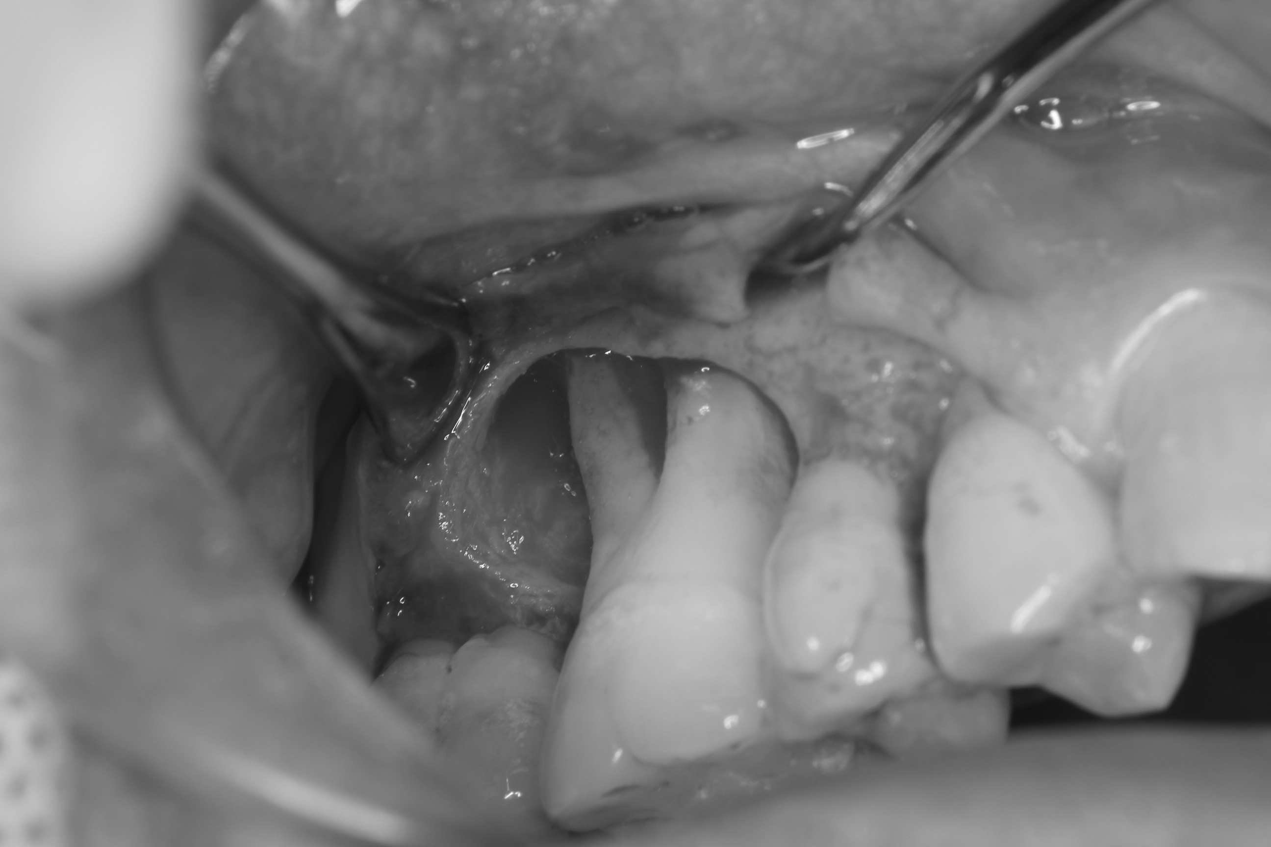 重度歯周病の治療 ～再生療法～ | 歯周病専門外来 たけのうち歯科
