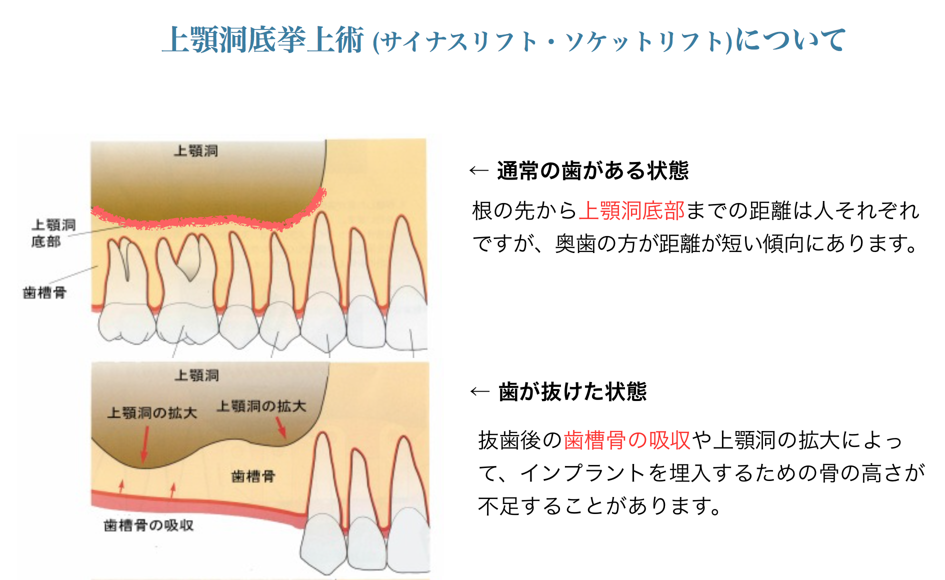 上顎洞挙上手術を併用した歯科治療』｜筒井歯科クリニック｜岡山市北区