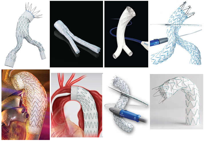 ステントグラフト治療 | 佐賀大学医学部 胸部・心臓血管外科