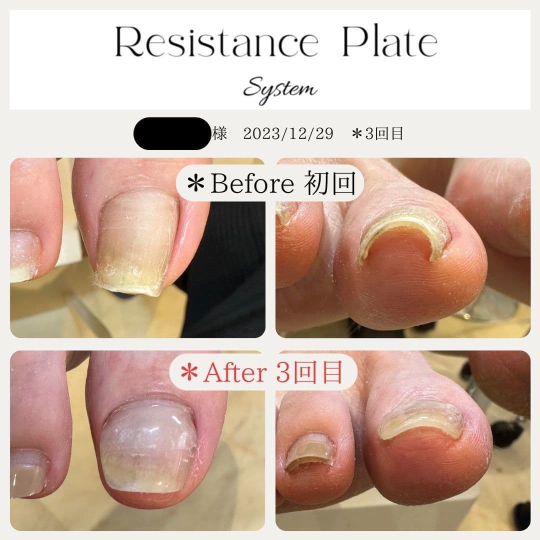レジスタンスプレート【巻き爪解放】申込フォーム of TOKYO NAIL+COLLEGE