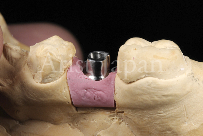 製品紹介｜大阪・歯科技工所 Arist Japan（アリストジャパン）