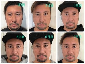 効果検証】話題の小顔スティック『Lala(ララ )』を実際に1ヶ月間使って