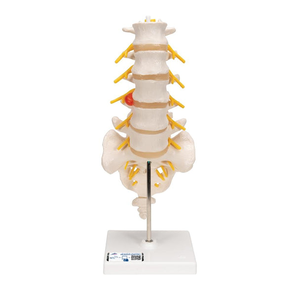 Lumbar Spinal Column with Dorso-lateral Prolapsed Intervertebral