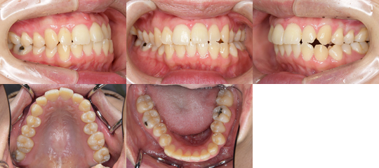 上顎咬合平面の左上がり傾斜と下顎骨左方偏位を呈する顔面非対称に対し