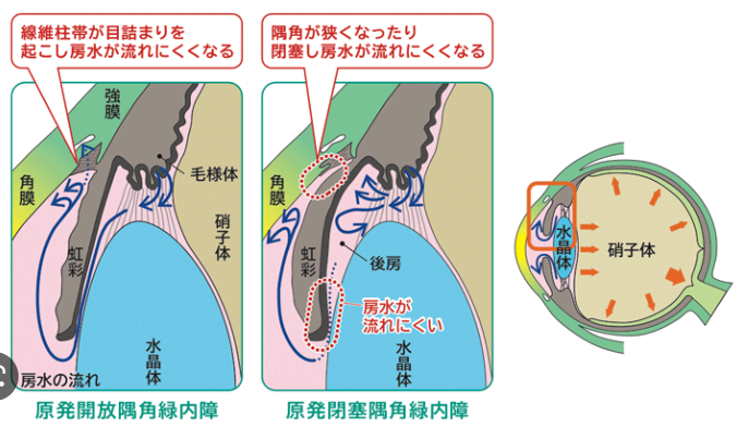 ブログ｜広島市南区,まつやま眼科/白内障,緑内障,硝子体の日帰り手術に対応