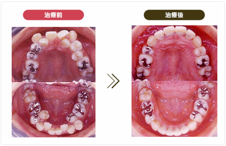 歯周矯正 GPがすべき五つの矯正治療 歯周矯正 GPがすべき五つの矯正