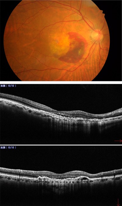 加齢黄斑変性について｜にしじま眼科 京都市中京区の眼科,白内障手術