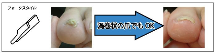 施術方法/巻き爪補正（巻き爪＆フットケアのペディグラス）