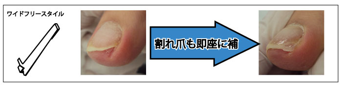 施術方法/巻き爪補正（巻き爪＆フットケアのペディグラス）