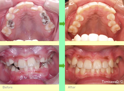 矯正治療の開始時期2＜調布市ー矯正歯科ーとみさわ歯科医院＞