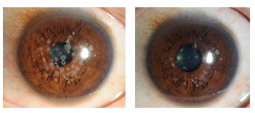 角膜手術 - 佐藤眼科グループ