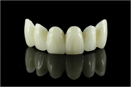 オールセラミックの守備範囲