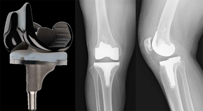 膝関節外科 | 関西医科大学整形外科学講座 - Part 1000