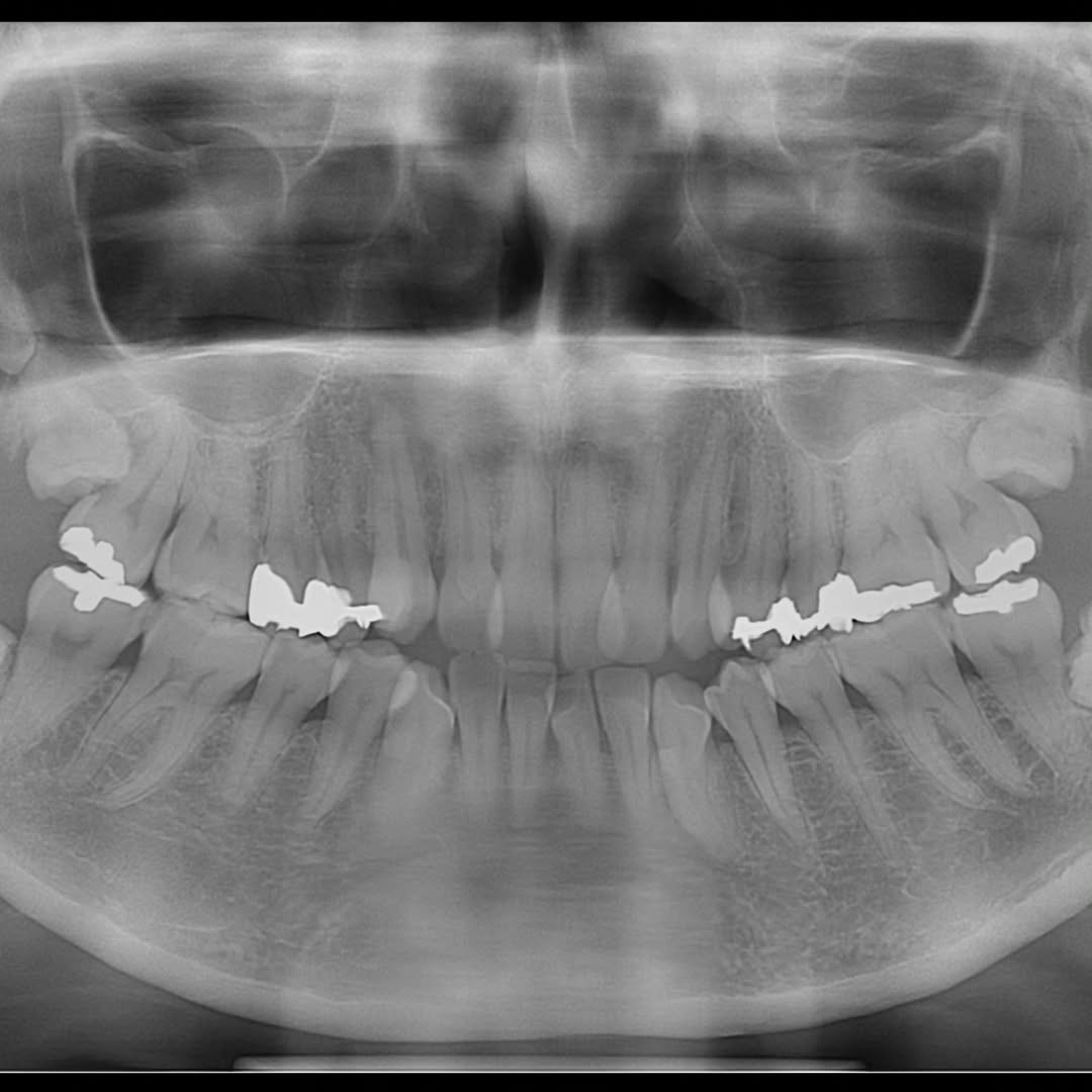 矯正治療と親知らず | 吉田歯科医院