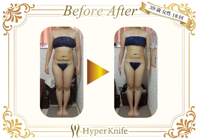 ハイパーナイフ | 広島市南区で口コミ上位 あさひ整骨院