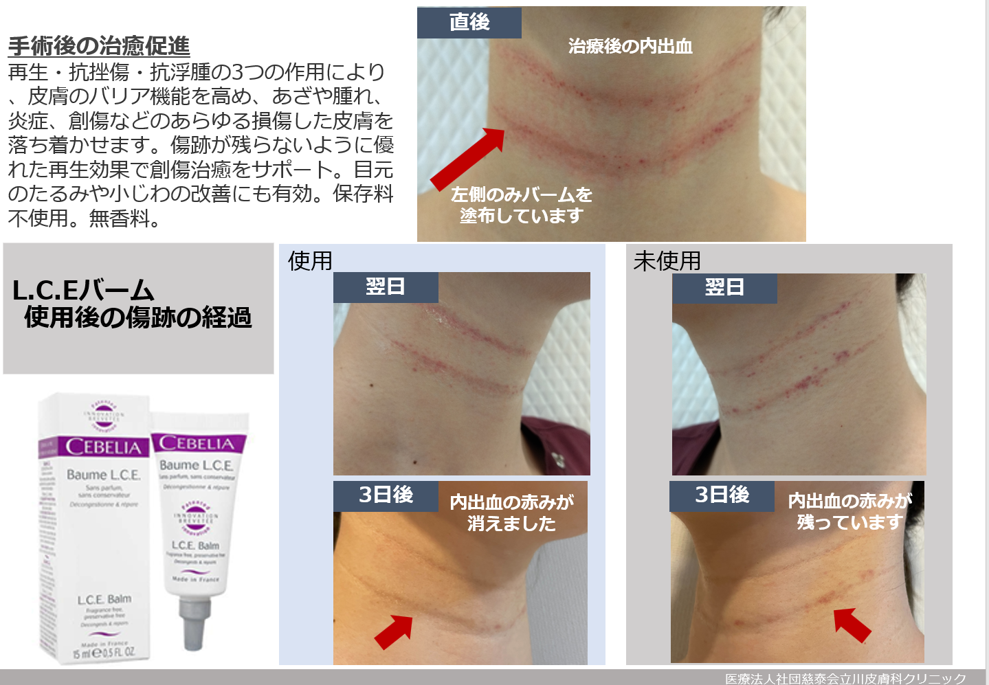 施術副作用軽減バーム✨ ｜立川皮膚科クリニック｜ニキビ、シミ