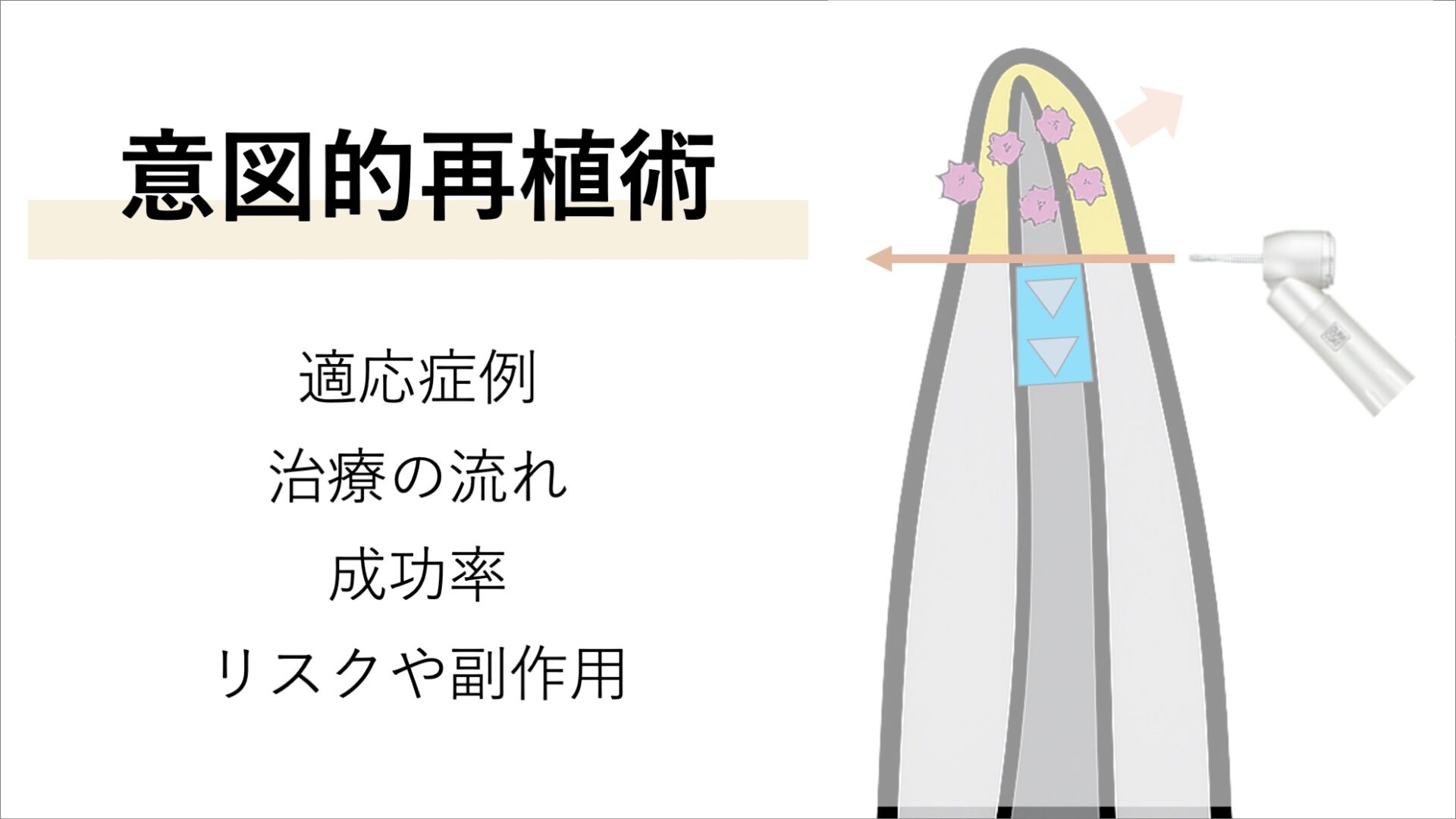意図的再植術とは？歯を抜いて戻す特殊な根管治療で歯を残す方法