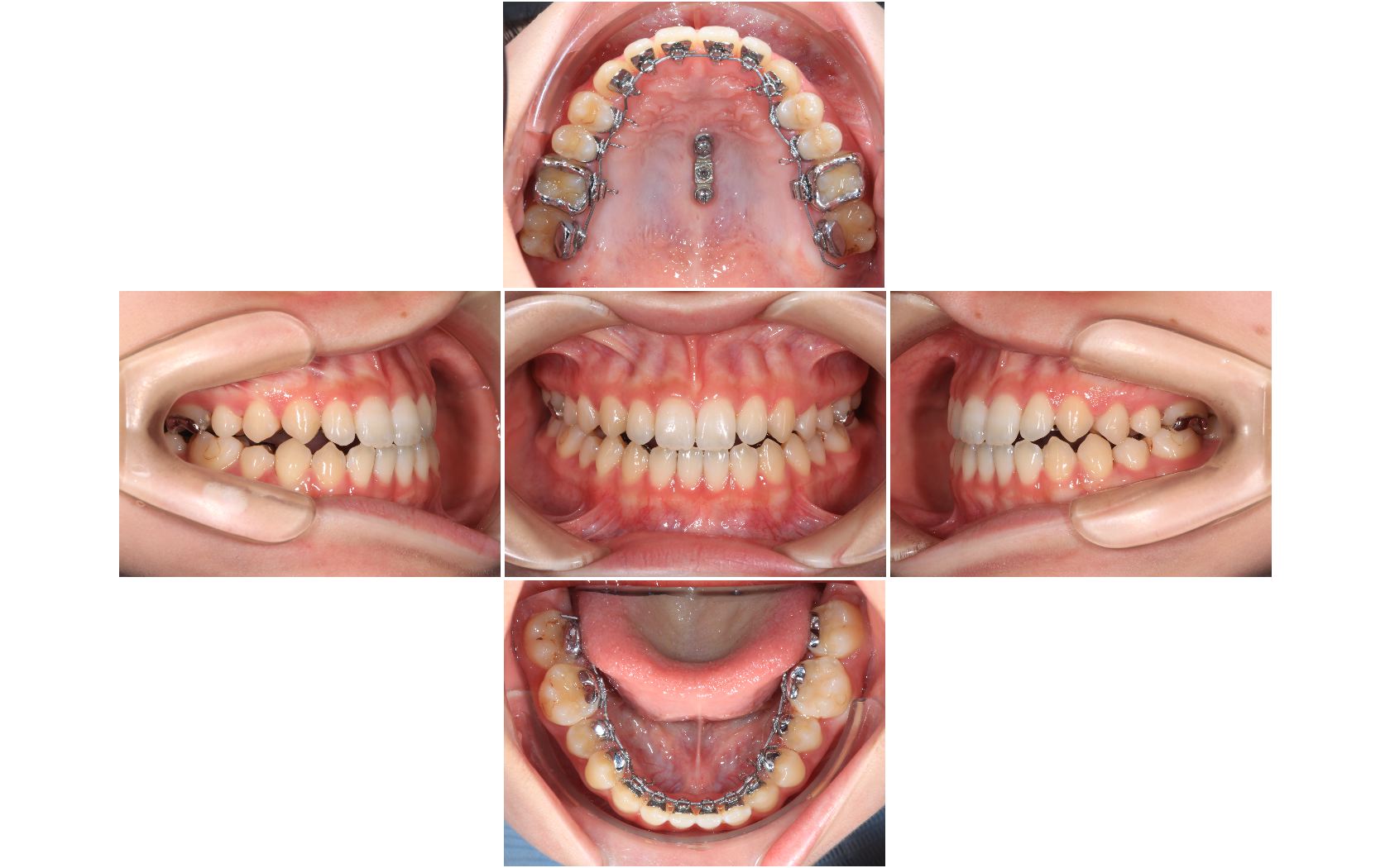 空隙歯列】歯の裏側からの矯正|【田隅矯正歯科クリニック】姫路駅直結