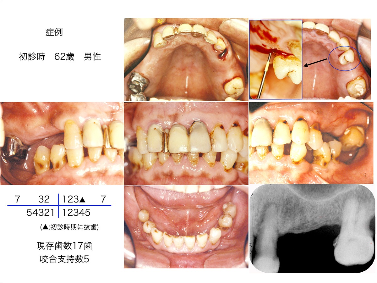 私の臨床ノート「欠損歯列をどう見るようになったか」（その3）欠損歯