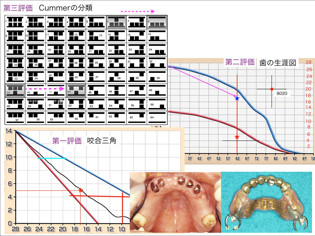 私の臨床ノート「欠損歯列をどう見るようになったか」（その3）欠損歯