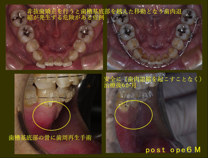 危険！？】非抜歯矯正のリスクについて症例で説明 - 東京日本橋AQUA