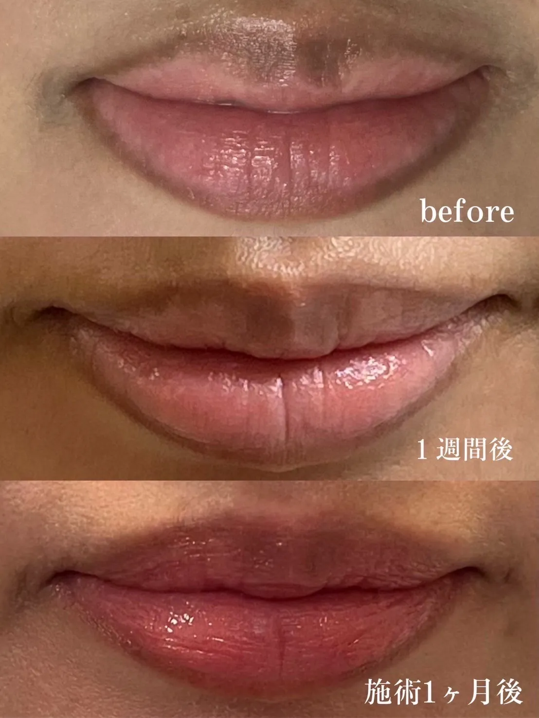 ローマピンク名古屋正規導入店/唇の黒ずみケア/ビフォーアフター