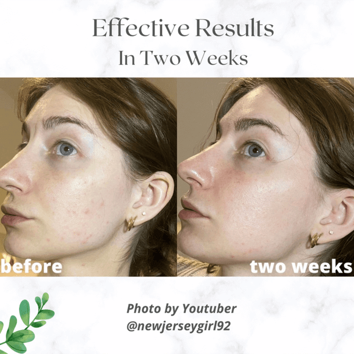 ZealSea Azelaic Acid 10% Facial Cream 1 Oz