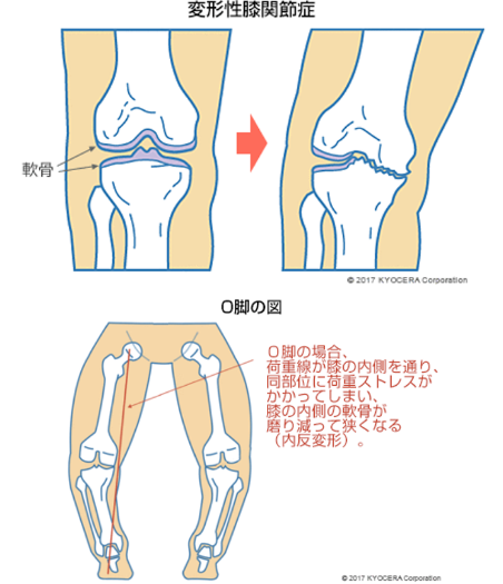 人工膝関節置換術 | 医療法人 大輪会 大橋・谷 整形外科