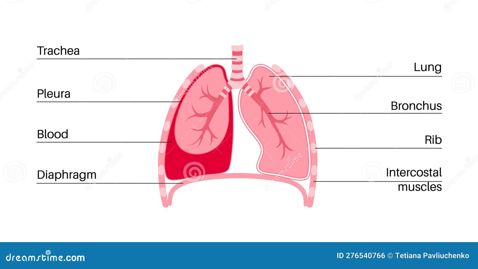 Hemothorax medical poster stock vector. Illustration of membrane