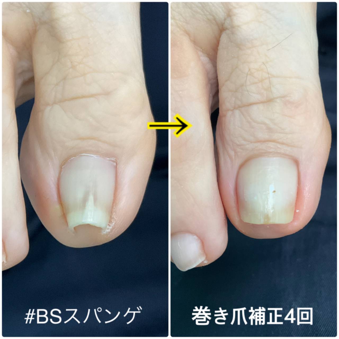 BS スパンゲ クイック 巻き爪 ビーエス 28スティック B/S おまけつき