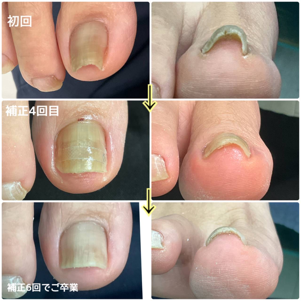 巻き爪、巻き爪補正はBSスパンゲ、看護師による爪ケア専門店 | サロン