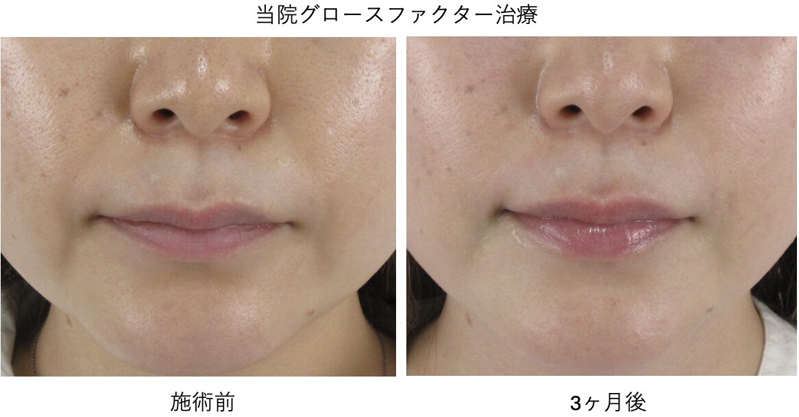 ほうれい線が“絶対消える”？ほぼ完全に消すための3つの手順を解説