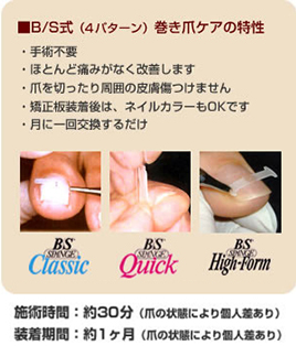 矯正方法について | 東京で巻き爪なら巻き爪矯正専門院 東京巻き爪センター