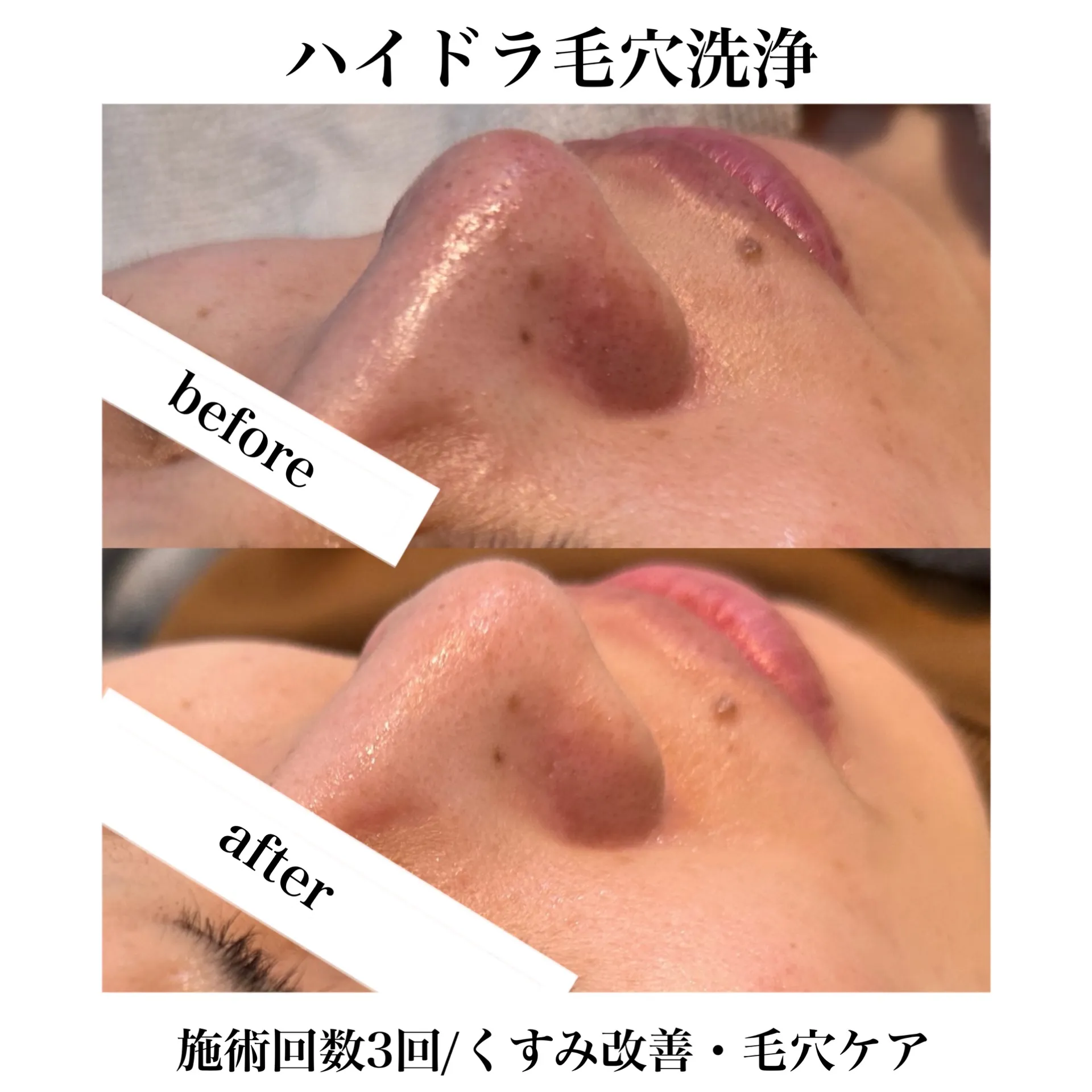 ハイドラ毛穴洗浄 | ギャラリー | 北九州でエステならTOTAL BEAUTY