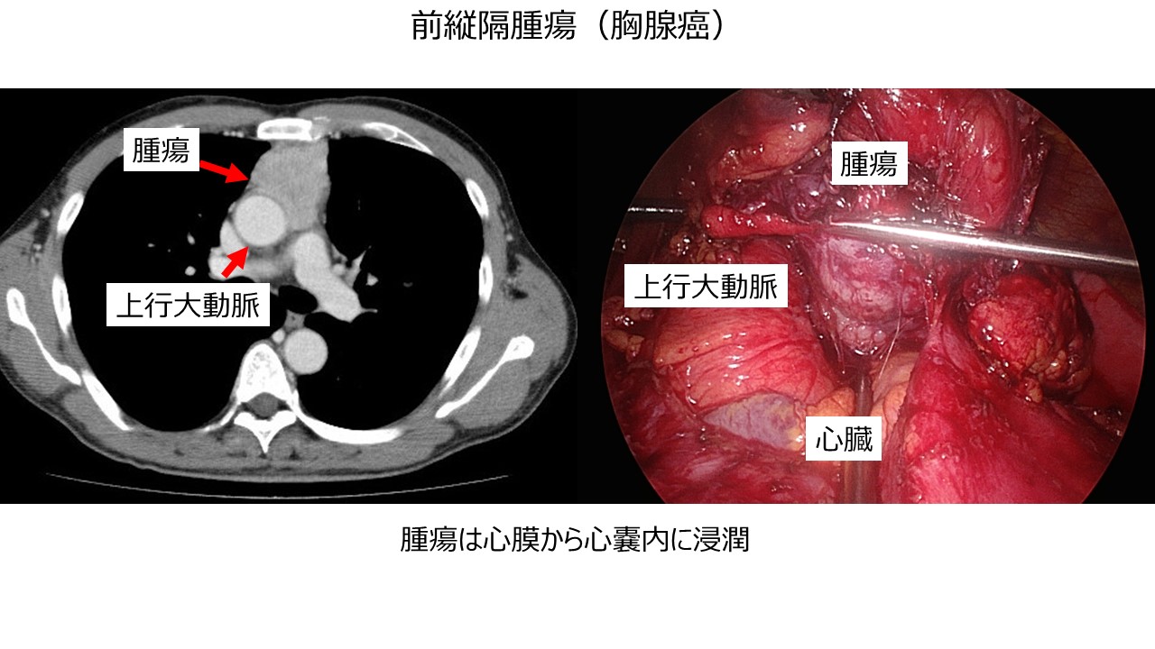 縦隔腫瘍 | 主な対象疾患 | 患者さん・ご家族の皆様 |東京科学大学病院