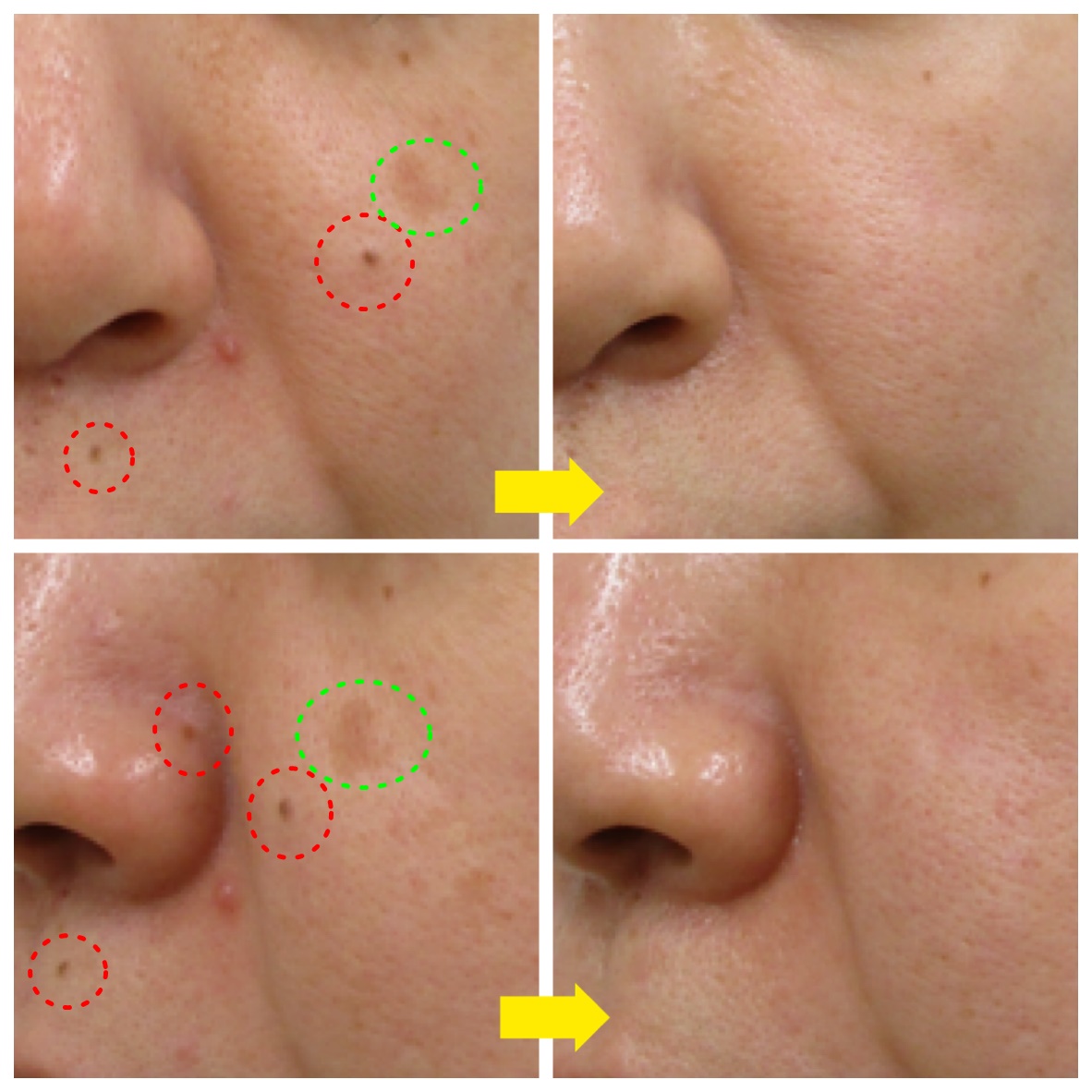 ホクロ取り&シミ取り | 福岡市城南区の美容皮膚科｜タケダビューティー