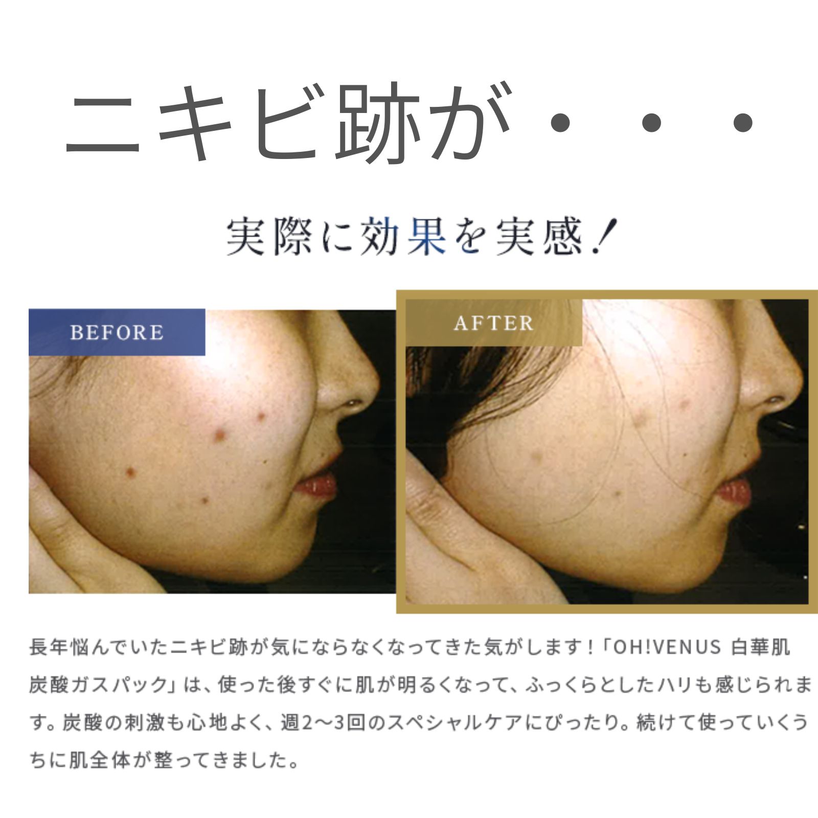 楽天市場】白華肌 SHIROHADA 炭酸ガスパック 炭酸ガス 10回分 グロー