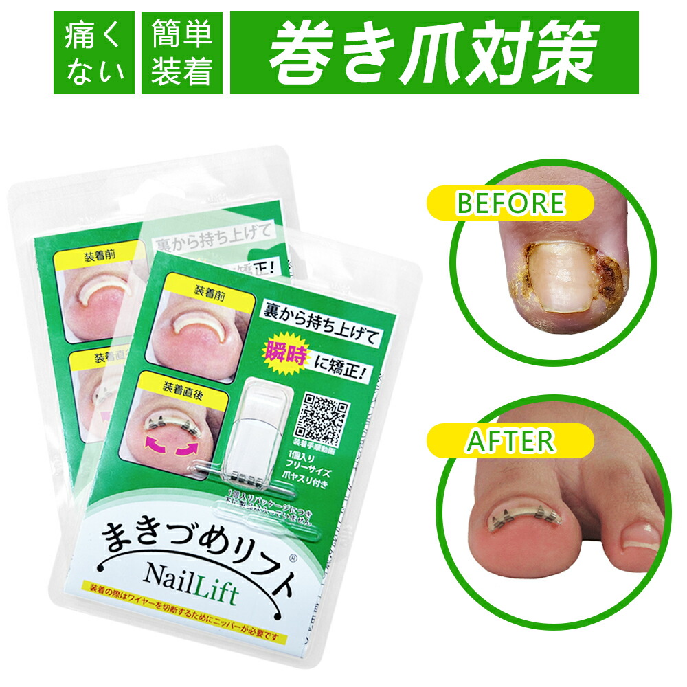 楽天市場】☆痛みにさようなら！☆毎日快適！巻き爪リフト まきづめ