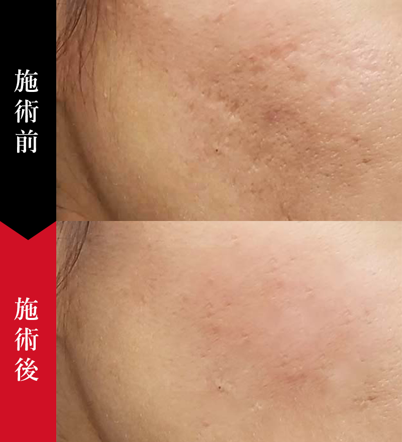 1年後のあなたは後悔していませんか？セルフダーマペンの失敗による