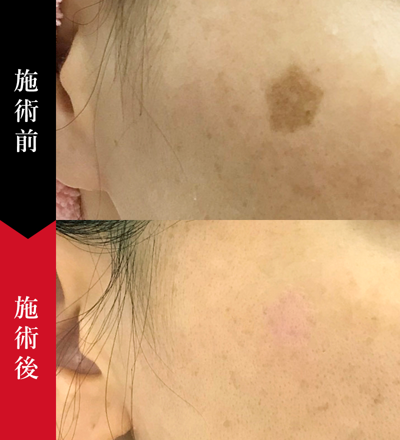 シミ取りレーザー (シミ取り放題) - 症例｜椿クリニック 銀座・名古屋